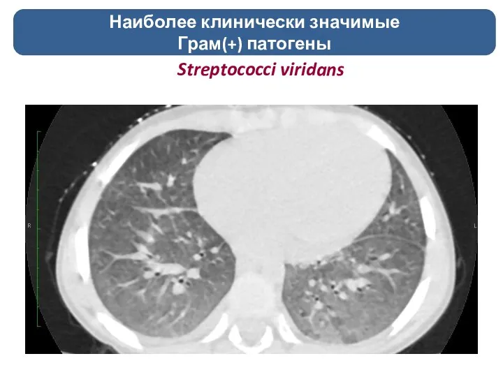 Streptococci viridans Наиболее клинически значимые Грам(+) патогены