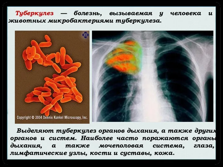 Туберкулез — болезнь, вызываемая у человека и животных микробактериями туберкулеза. Выделяют