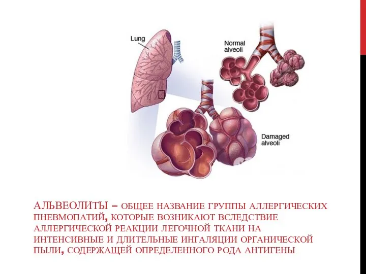 АЛЬВЕОЛИТЫ – ОБЩЕЕ НАЗВАНИЕ ГРУППЫ АЛЛЕРГИЧЕСКИХ ПНЕВМОПАТИЙ, КОТОРЫЕ ВОЗНИКАЮТ ВСЛЕДСТВИЕ АЛЛЕРГИЧЕСКОЙ