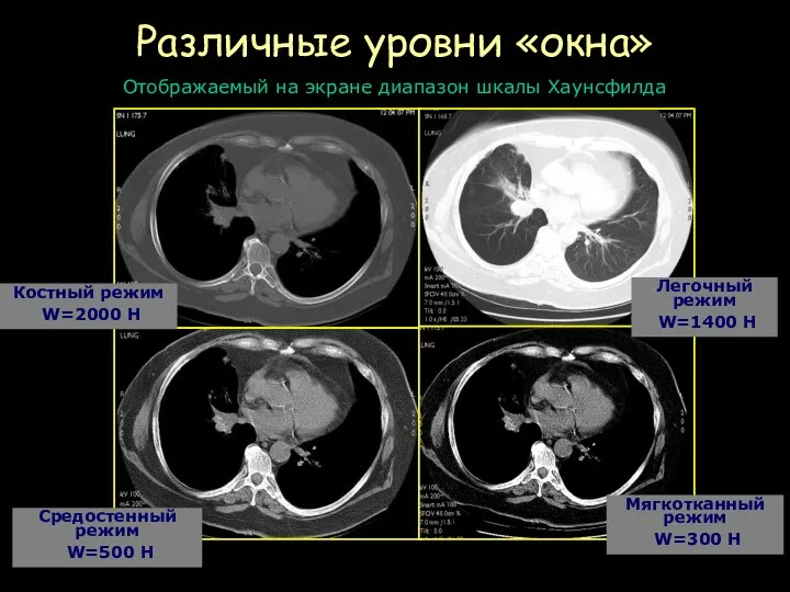 Различные уровни «окна» Костный режим W=2000 H Легочный режим W=1400 H