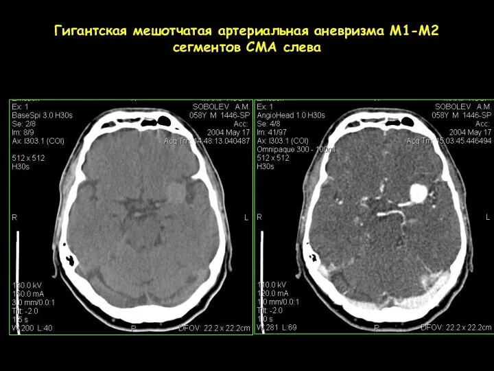 Гигантская мешотчатая артериальная аневризма М1-М2 сегментов СМА слева