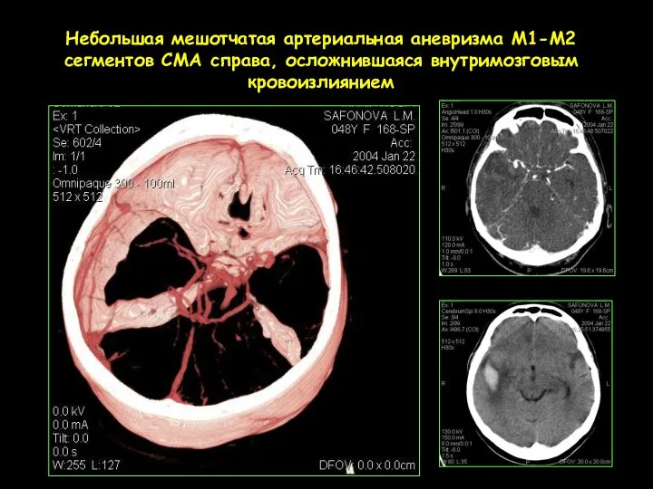 Небольшая мешотчатая артериальная аневризма М1-М2 сегментов СМА справа, осложнившаяся внутримозговым кровоизлиянием