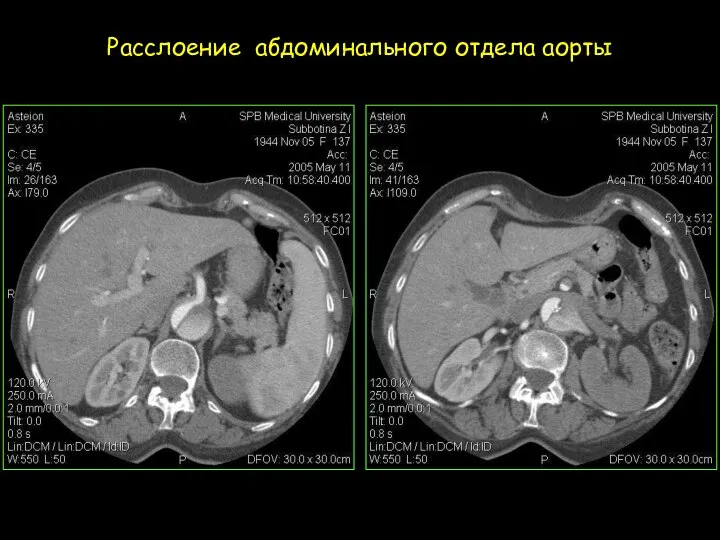 Расслоение абдоминального отдела аорты