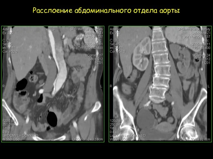 Расслоение абдоминального отдела аорты