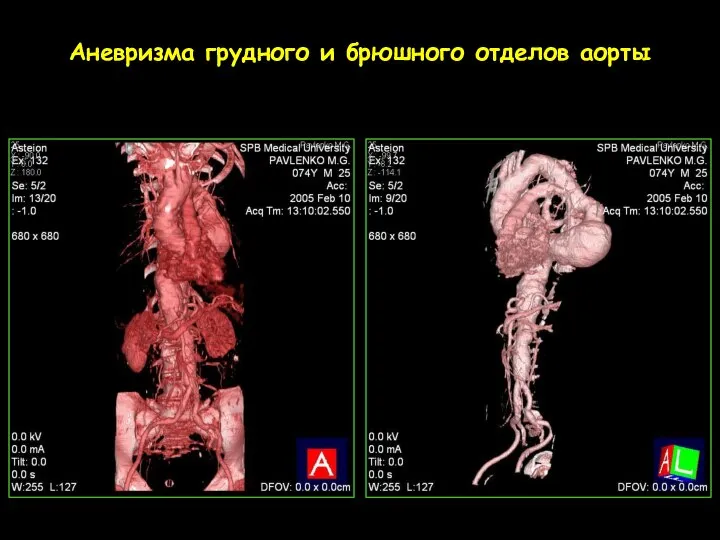 Аневризма грудного и брюшного отделов аорты