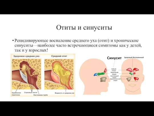 Отиты и синуситы Рецидивирующее воспаление среднего уха (отит) и хронические синуситы—наиболее