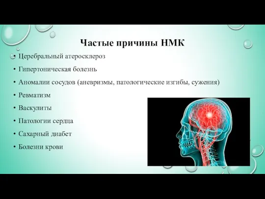 Частые причины НМК Церебральный атеросклероз Гипертоническая болезнь Аномалии сосудов (аневризмы, патологические