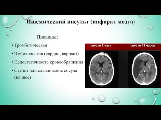 Ишемический инсульт (инфаркт мозга) Причины : Тромботическая Эмболическая (кардио, варикоз) Недостаточность