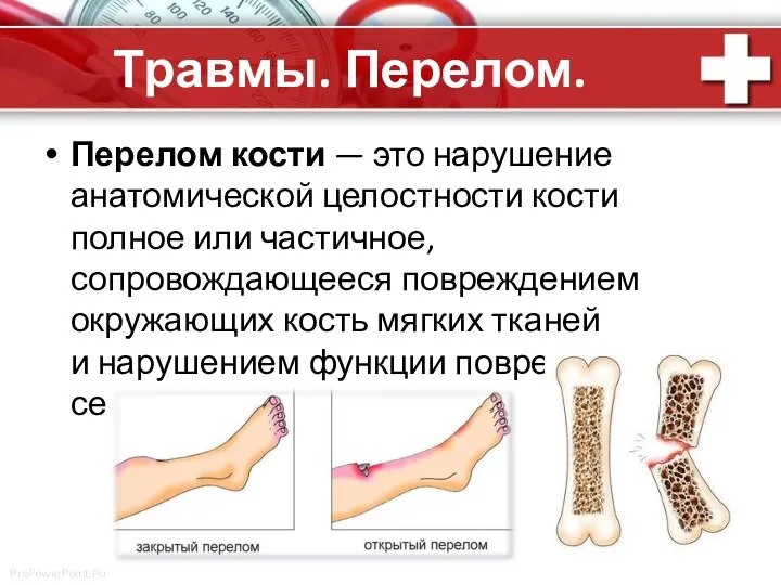 Травмы. Перелом. Перелом кости — это нарушение анатомической целостности кости полное