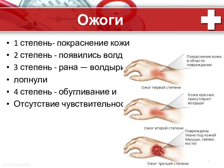 Ожоги 1 степень- покраснение кожи 2 степень - появились волдыри 3