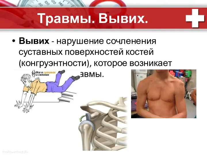 Травмы. Вывих. Вывих - нарушение сочленения суставных поверхностей костей (конгруэнтности), которое возникает вследствие травмы.