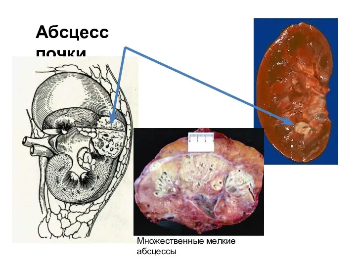 Абсцесс почки Множественные мелкие абсцессы