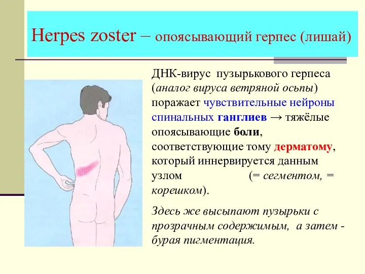 Herpes zoster – опоясывающий герпес (лишай) ДНК-вирус пузырькового герпеса (аналог вируса