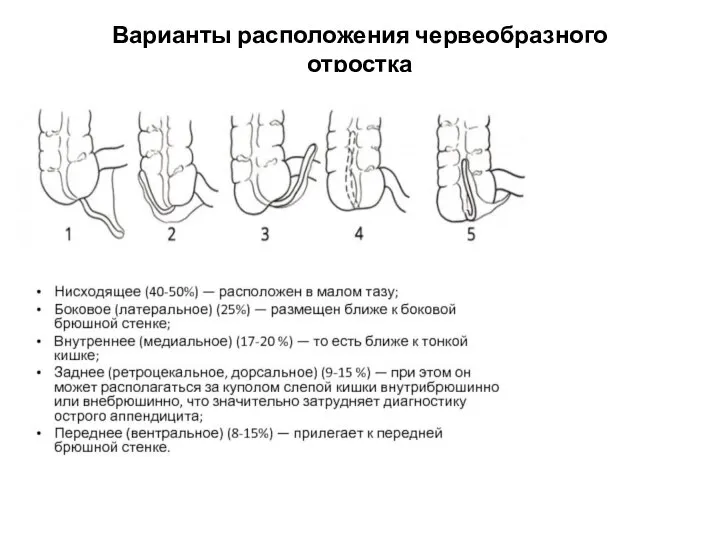 Варианты расположения червеобразного отростка