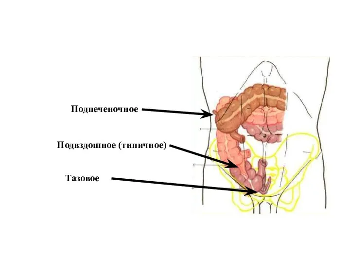 Подпеченочное Подвздошное (типичное) Тазовое