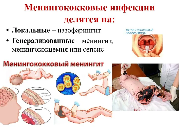 Менингококковые инфекции делятся на: Локальные – назофарингит Генерализованные – менингит, менингококцемия или сепсис