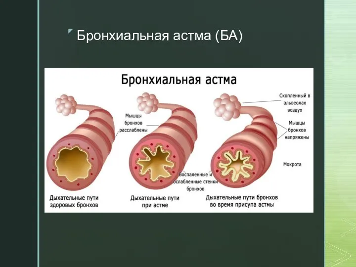 Бронхиальная астма (БА)