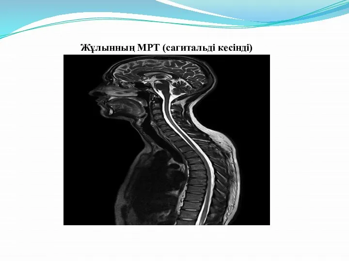 Жұлынның МРТ (сагитальді кесінді)