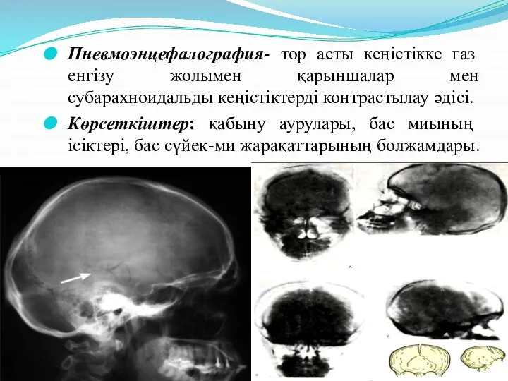Пневмоэнцефалография- тор асты кеңістікке газ енгізу жолымен қарыншалар мен субарахноидальды кеңістіктерді
