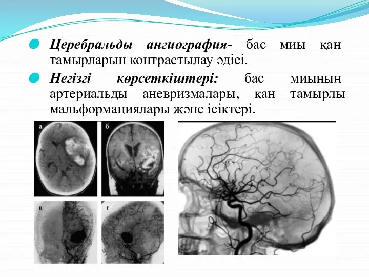 Церебральды ангиография- бас миы қан тамырларын контрастылау әдісі. Негізгі көрсеткіштері: бас