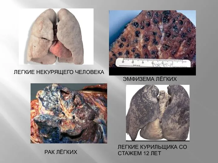 ЭМФИЗЕМА ЛЁГКИХ ЛЕГКИЕ НЕКУРЯЩЕГО ЧЕЛОВЕКА ЛЕГКИЕ КУРИЛЬЩИКА СО СТАЖЕМ 12 ЛЕТ РАК ЛЁГКИХ