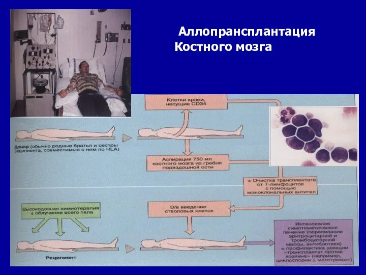 Аллопрансплантация Костного мозга