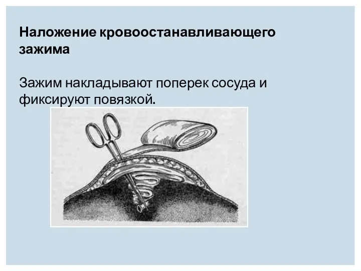 Наложение кровоостанавливающего зажима Зажим накладывают поперек сосуда и фиксируют повязкой.