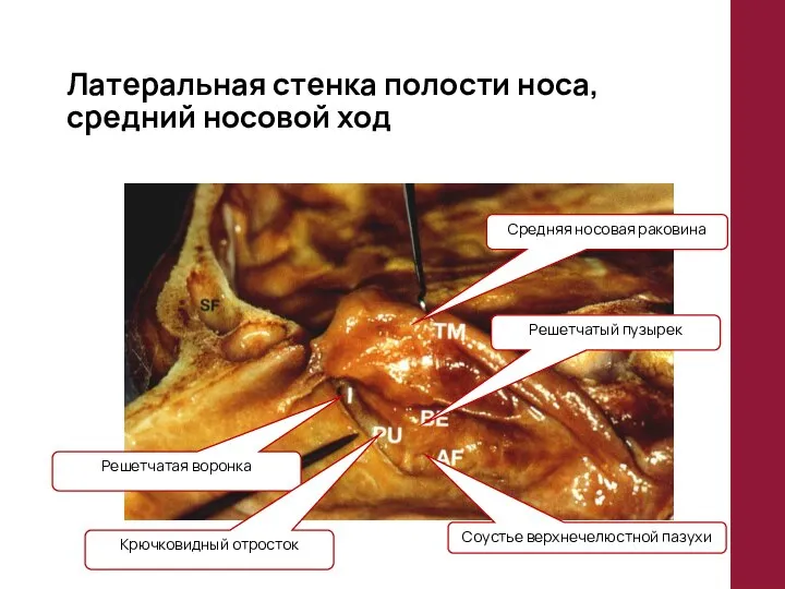 Латеральная стенка полости носа, средний носовой ход Решетчатая воронка Решетчатый пузырек