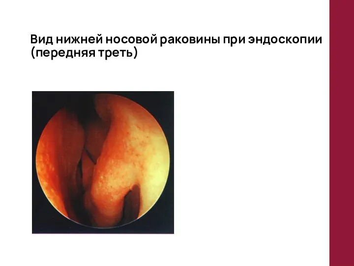 Вид нижней носовой раковины при эндоскопии (передняя треть)