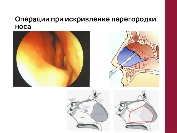 Операции при искривление перегородки носа