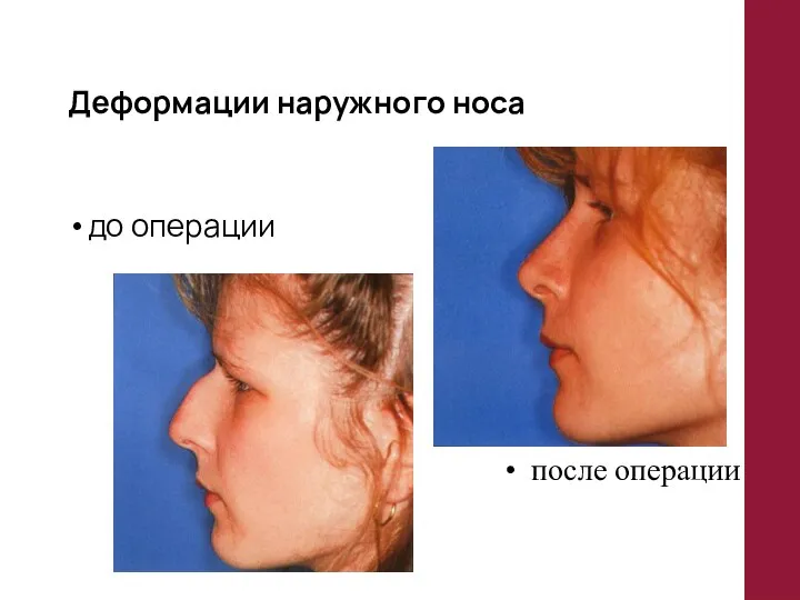 Деформации наружного носа до операции после операции