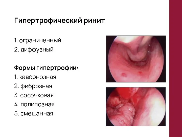 Гипертрофический ринит 1. ограниченный 2. диффузный Формы гипертрофии: 1. кавернозная 2.