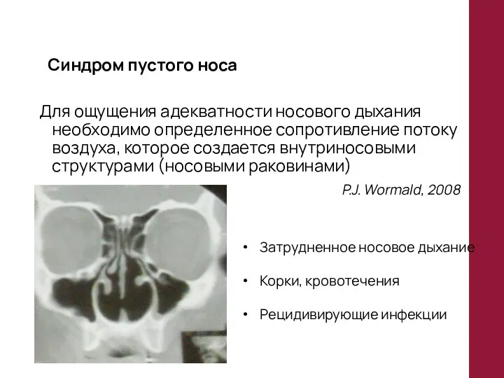 Синдром пустого носа Для ощущения адекватности носового дыхания необходимо определенное сопротивление