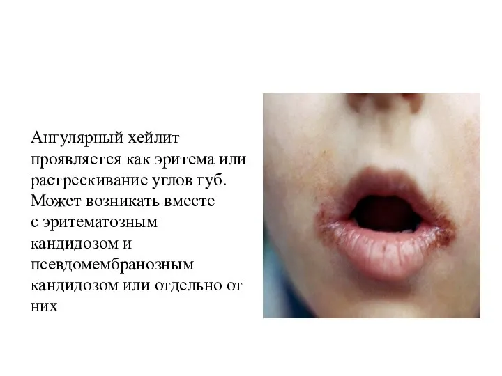 Ангулярный хейлит проявляется как эритема или растрескивание углов губ. Может возникать
