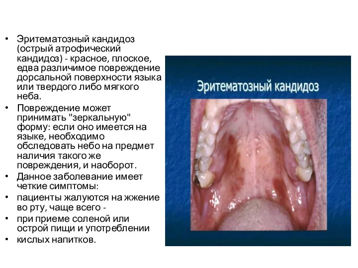 Эритематозный кандидоз (острый атрофический кандидоз) - красное, плоское, едва различимое повреждение