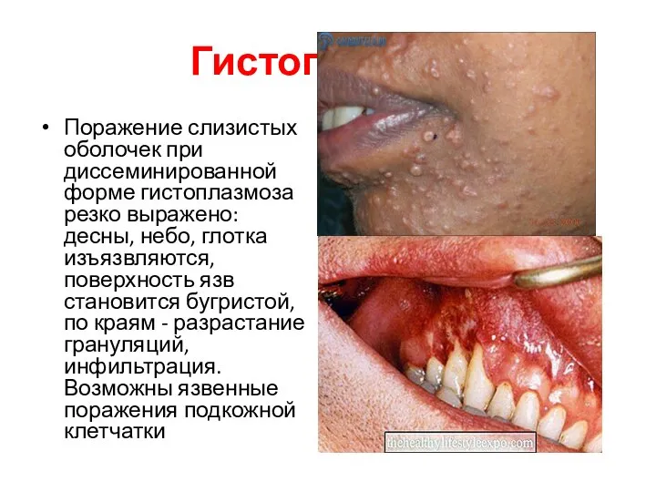 Гистоплазмоз Поражение слизистых оболочек при диссеминированной форме гистоплазмоза резко выражено: десны,