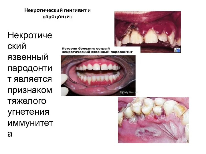 Некротический гингивит и пародонтит Некротический язвенный пародонтит является признаком тяжелого угнетения иммунитета