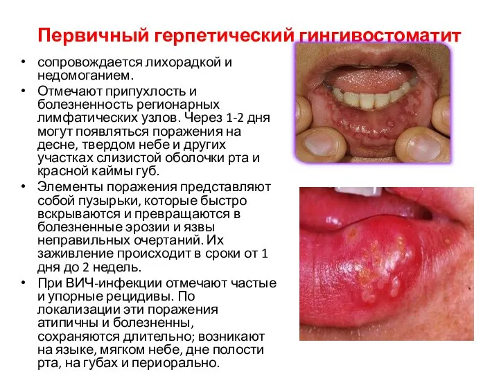 Первичный герпетический гингивостоматит сопровождается лихорадкой и недомоганием. Отмечают припухлость и болезненность