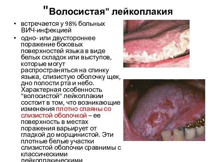 "Волосистая" лейкоплакия встречается у 98% больных ВИЧ-инфекцией одно- или двустороннее поражение