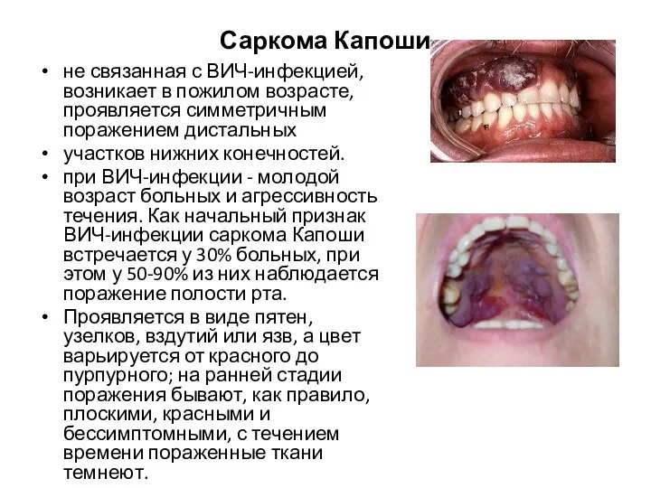 Саркома Капоши не связанная с ВИЧ-инфекцией, возникает в пожилом возрасте, проявляется