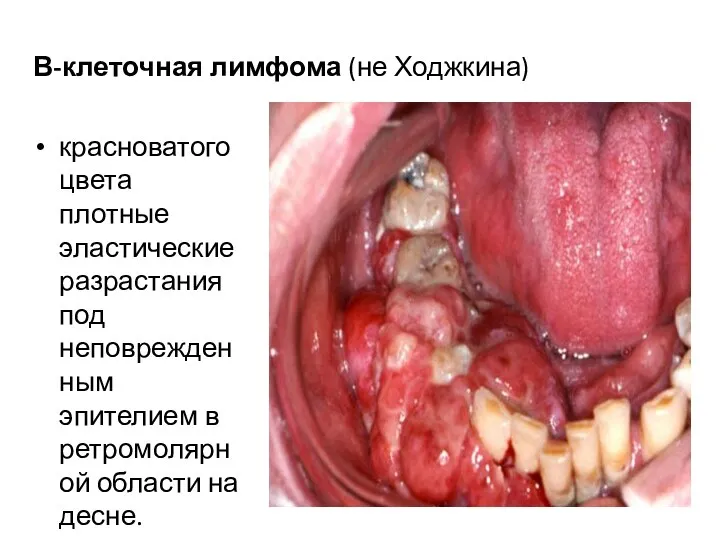 В-клеточная лимфома (не Ходжкина) красноватого цвета плотные эластические разрастания под неповрежденным