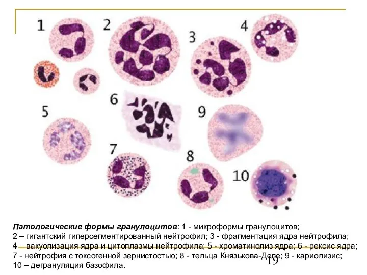 Патологические формы гранулоцитов: 1 - микроформы гранулоцитов; 2 – гигантский гиперсегментированный