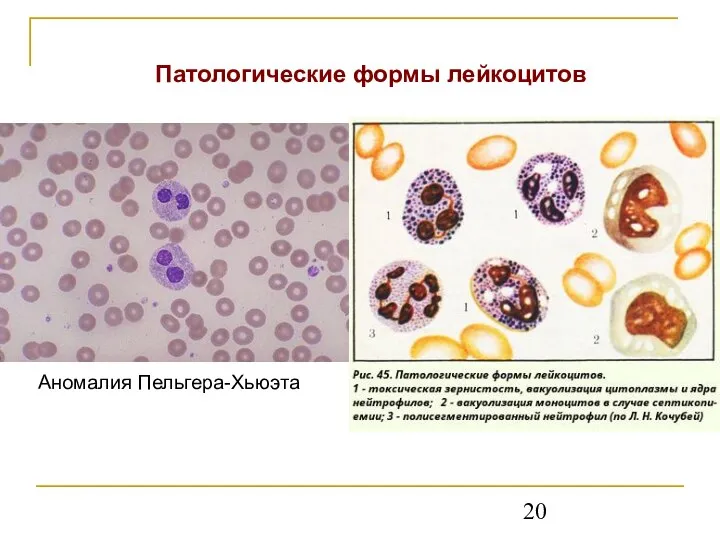 Аномалия Пельгера-Хьюэта Патологические формы лейкоцитов