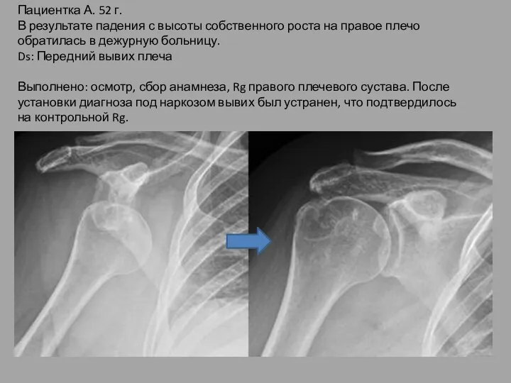 Пациентка А. 52 г. В результате падения с высоты собственного роста