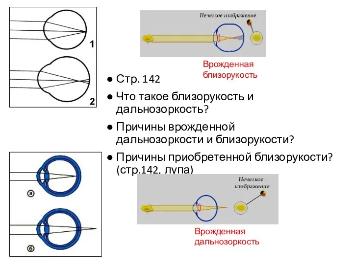 Стр. 142 Что такое близорукость и дальнозоркость? Причины врожденной дальнозоркости и