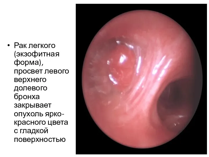 Рак легкого (экзофитная форма), просвет левого верхнего долевого бронха закрывает опухоль ярко-красного цвета с гладкой поверхностью