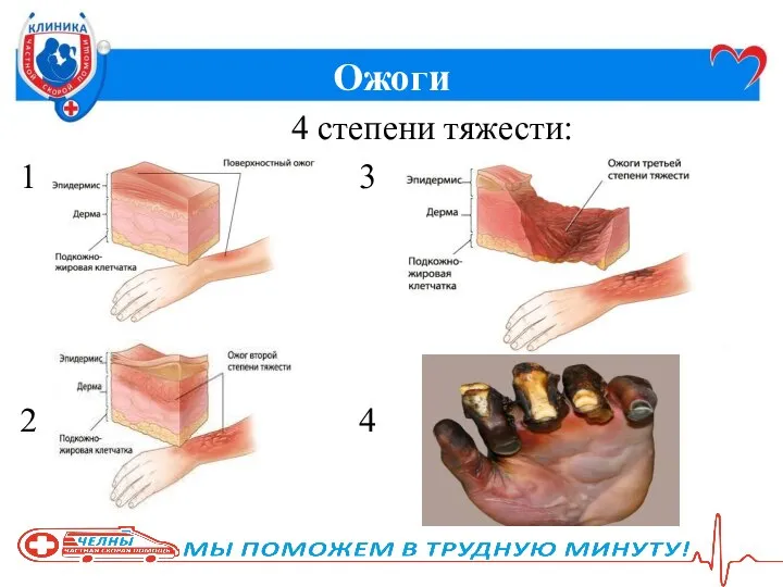 Ожоги 4 степени тяжести: 1 3 2 4