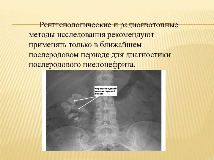 Рентгенологические и радиоизотопные методы исследования рекомендуют применять только в ближайшем послеродовом периоде для диагностики послеродового пиелонефрита.