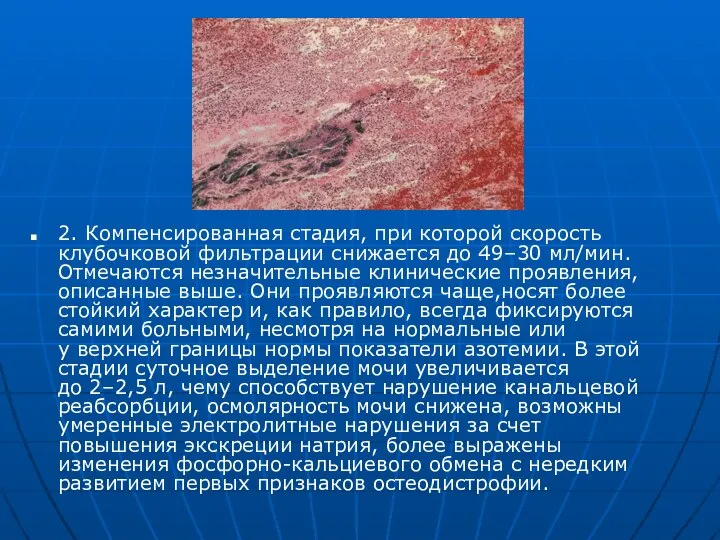 2. Компенсированная стадия, при которой скорость клубочковой фильтрации снижается до 49–30