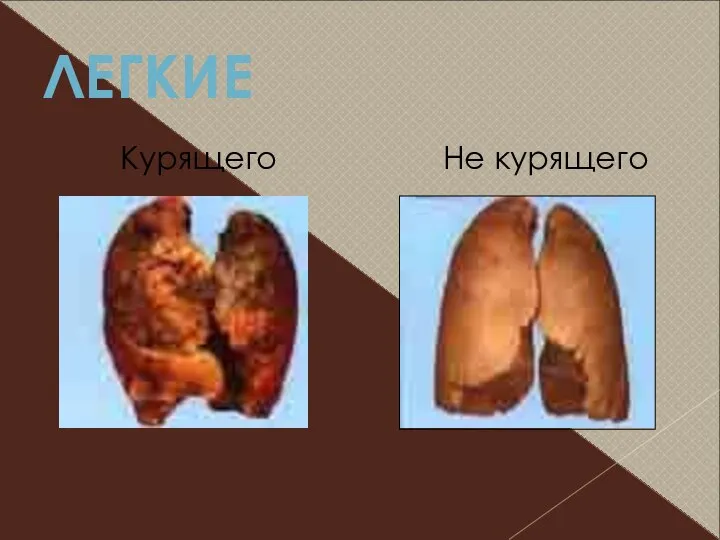 ЛЕГКИЕ Курящего Не курящего